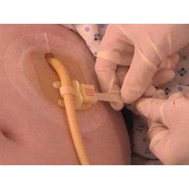 مثبت انبوب او  القسطرة البولية اتجاه عرضي من Hollister Hollister Horizontal Tube Attachment Device (HTAD)